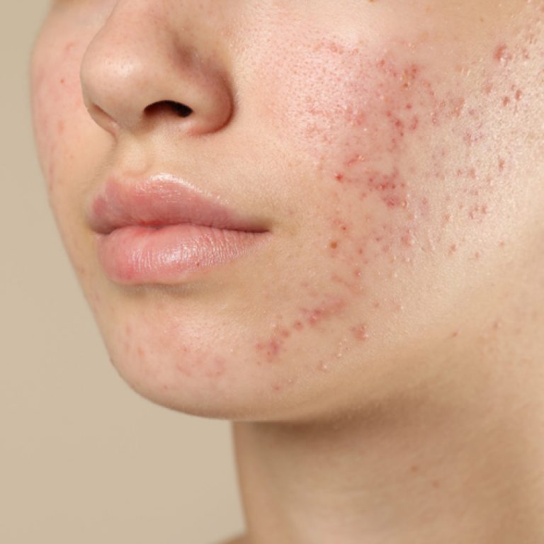 akne