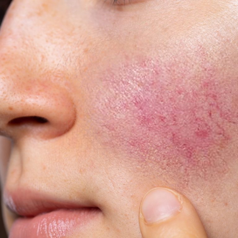 rosacea